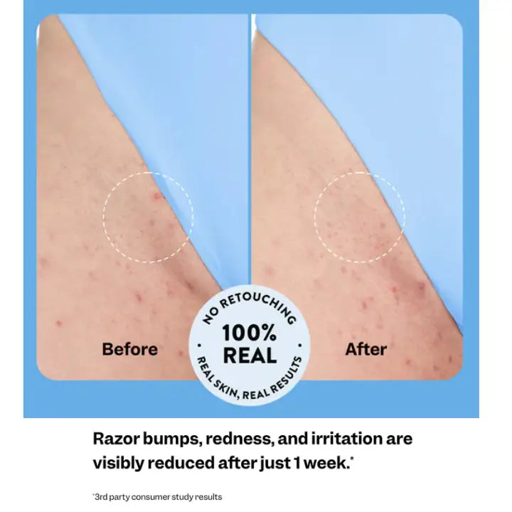 SmoothPure - Ingrown Hair Treatment