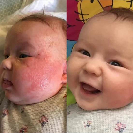 Eczema Soothing Cream